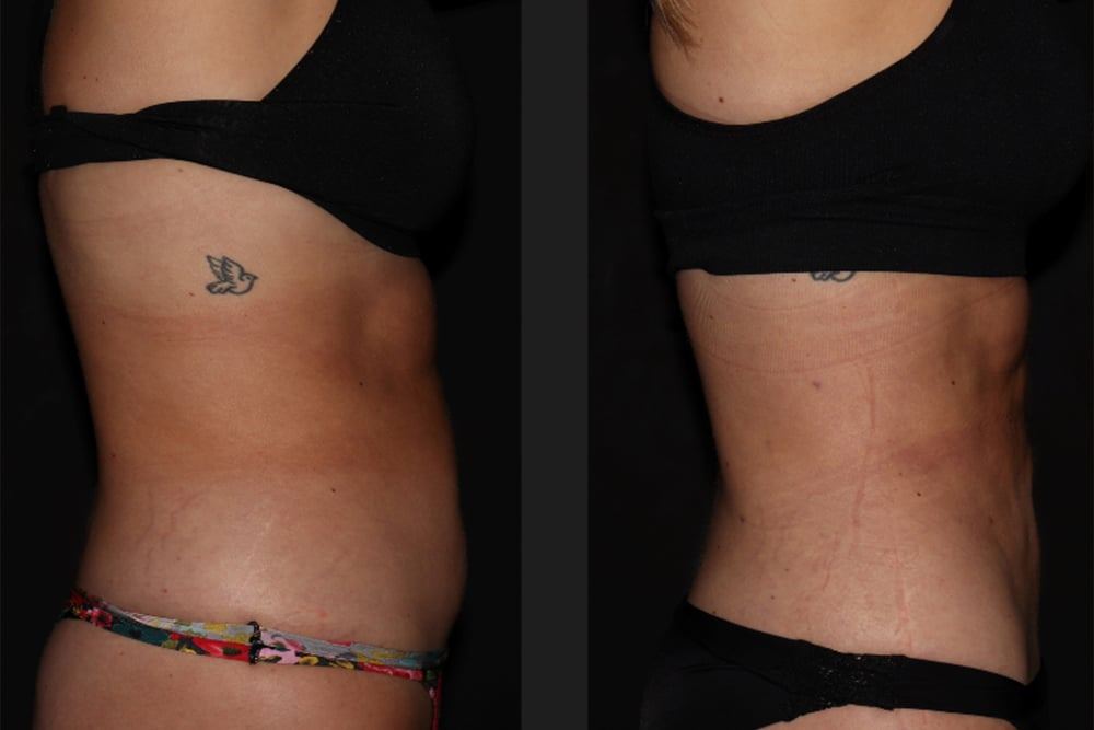 Get Body Sculpted